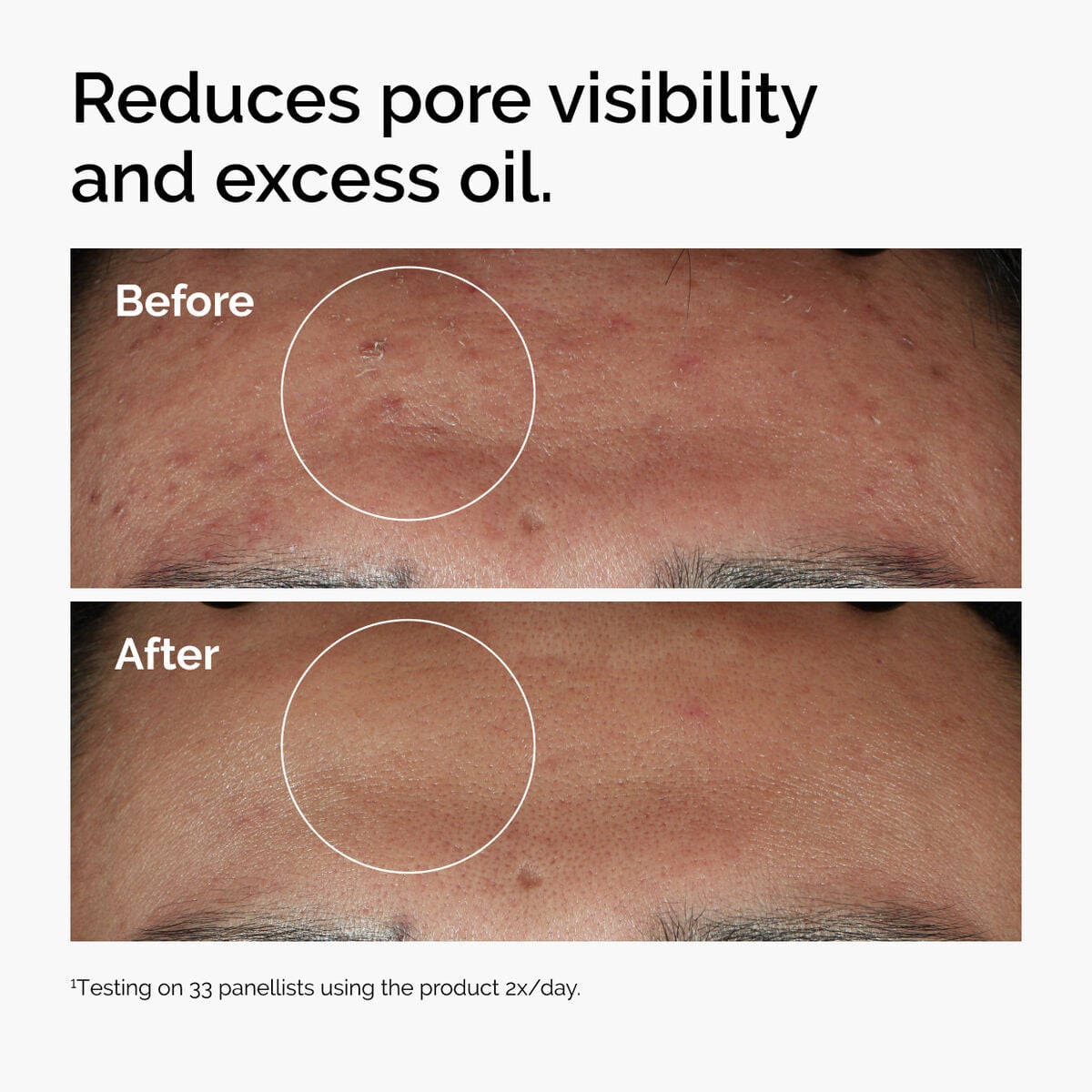niacinamide-10-zinc-1-l3 ord-niacinamide-zinc-blemish-serum-before-after-pores.jpg