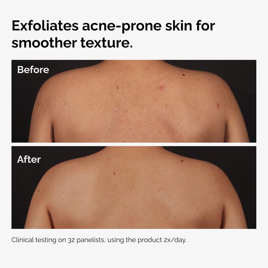 the-body-care-collection-h4 ord-salicylic-acid-body-serum-before-after-graphic-NA.jpg
