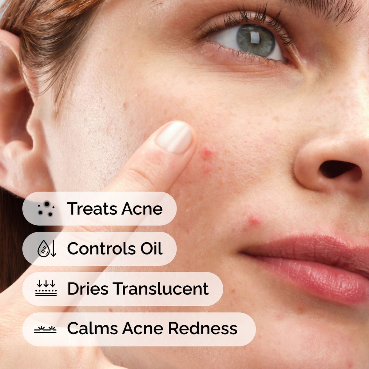 sulfur-10-powder-to-cream-concentrate-b9 ord-sulfur-10pct-powder-to-cream-concentrate-model-application-with-benefits-acne.jpg